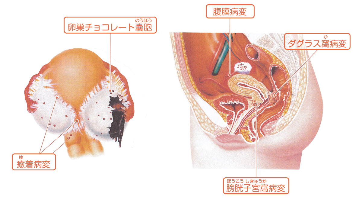 子宮内膜症/チョコレート嚢胞